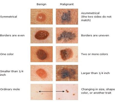 benign melanoma vs malignant melanoma